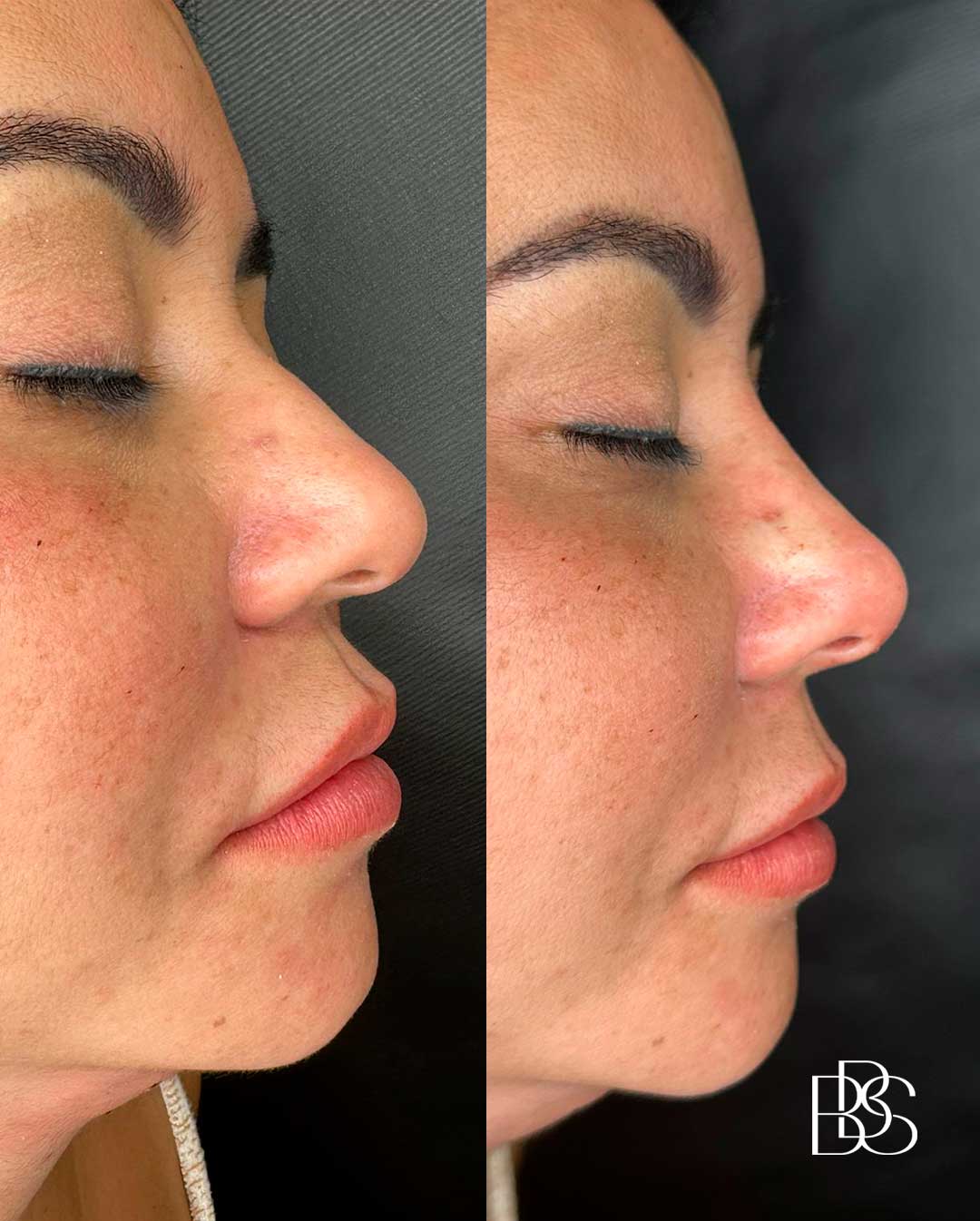 especialista-em-preenchimento-facial-no-nariz