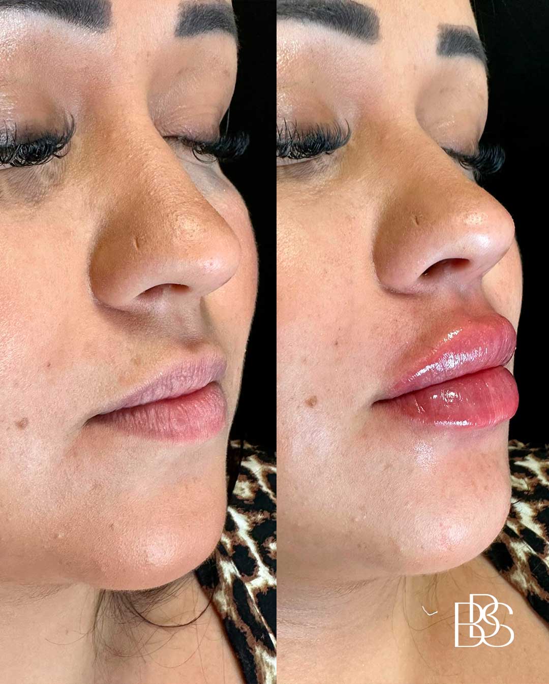 especialista-em-preenchimento-labial-são-joão-del-rei