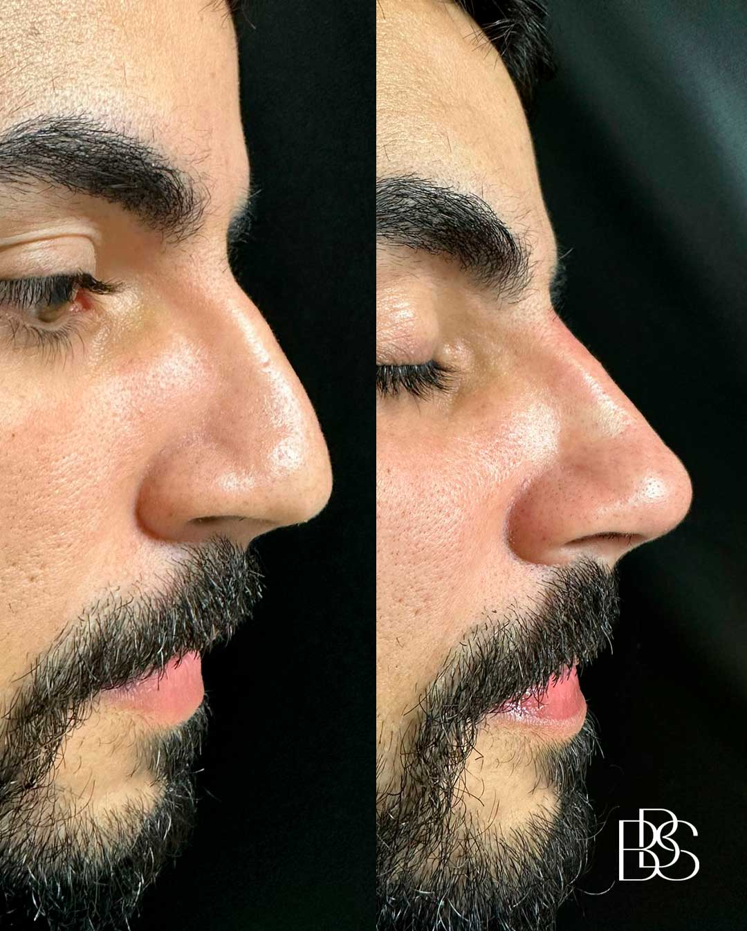 preenchimento-facial-nariz-são-joão-del-rei