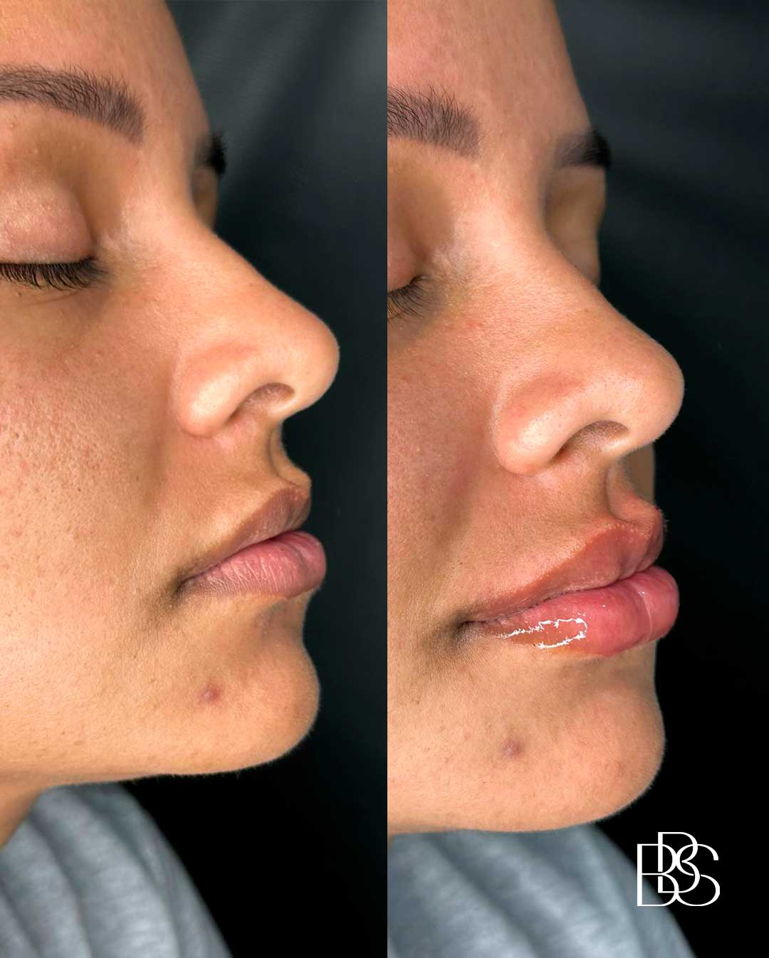 preenchimento-labial-não-exagerado