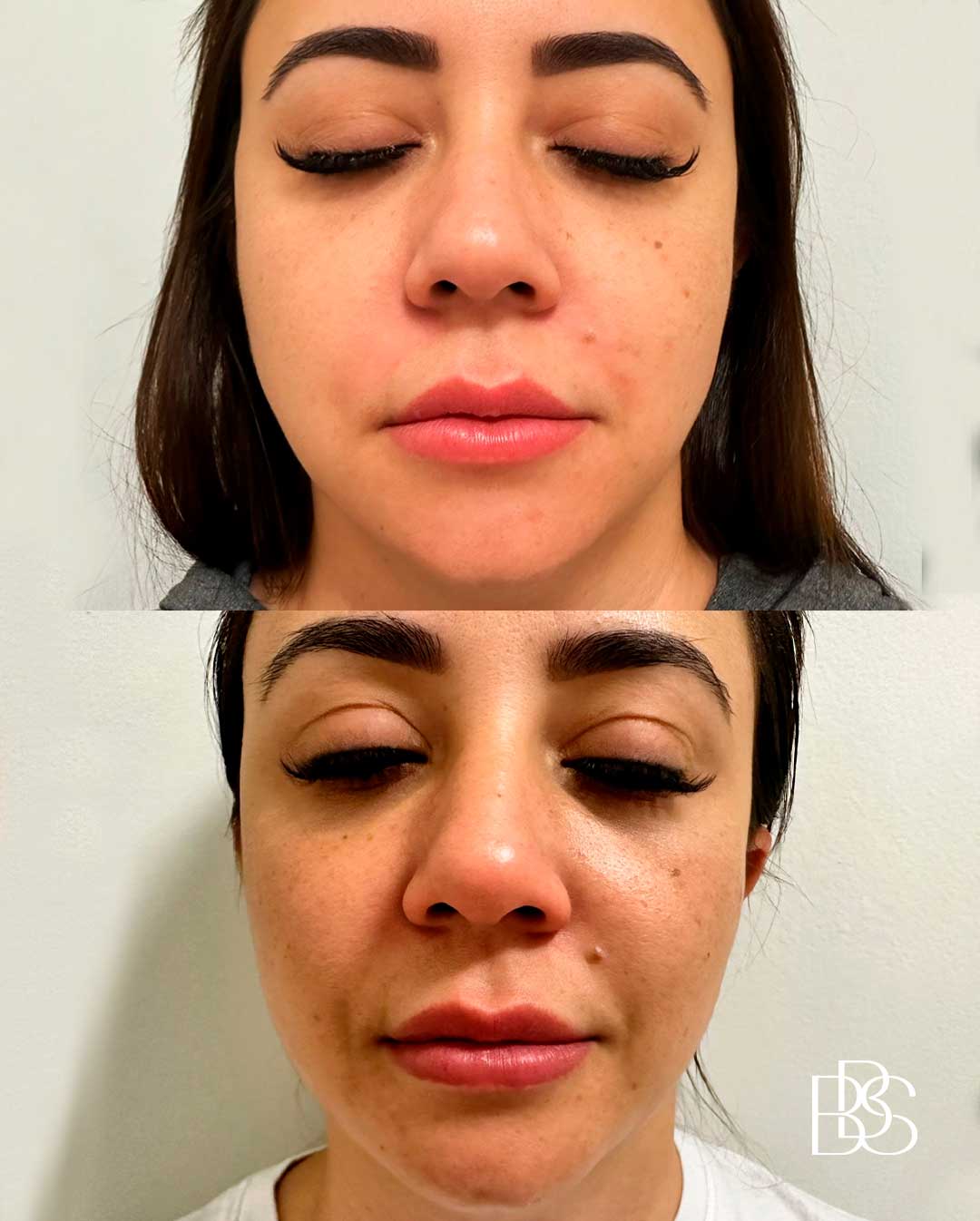preenchimento-labial-natural