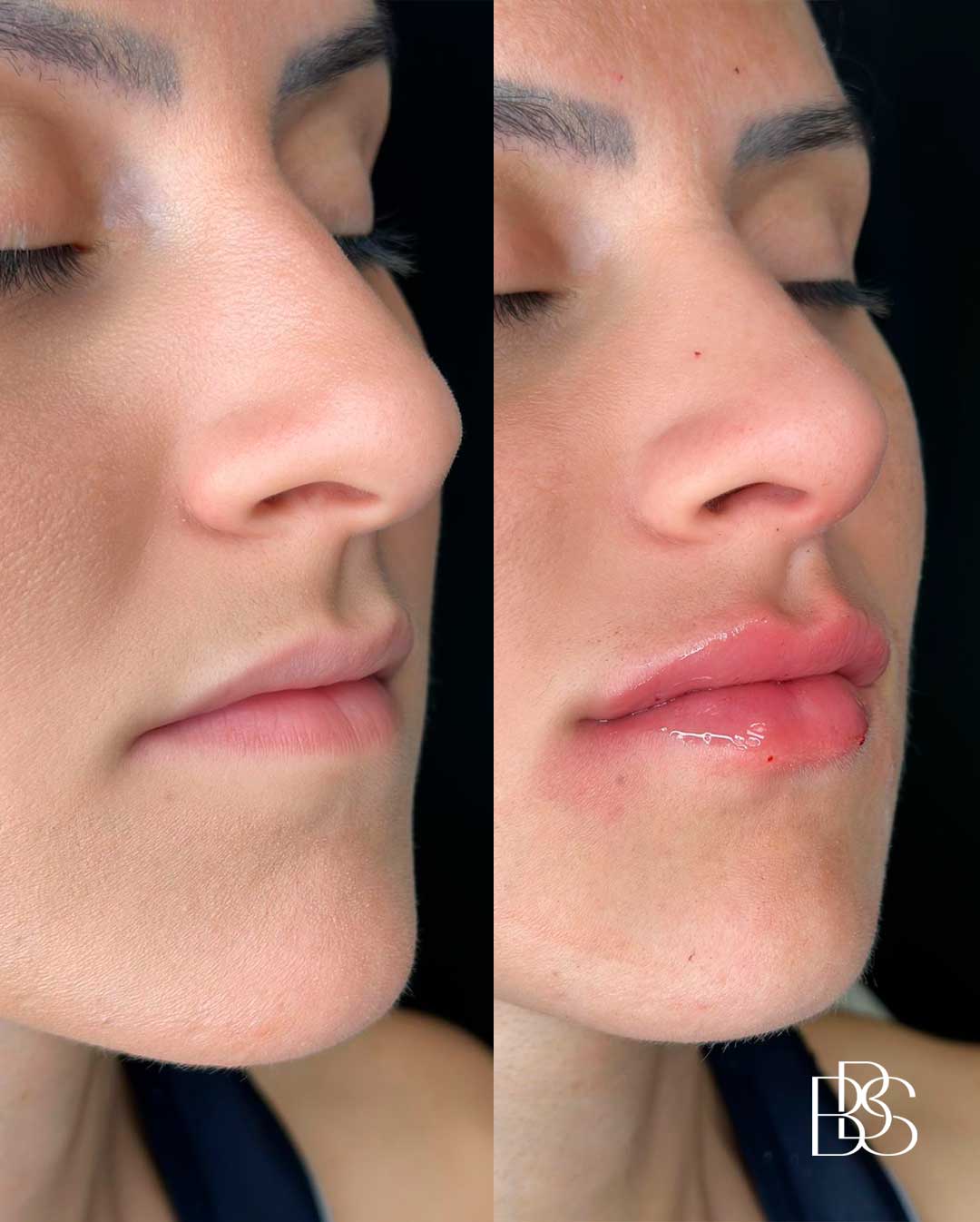 preenchimento-labial-são-joão-del-rei