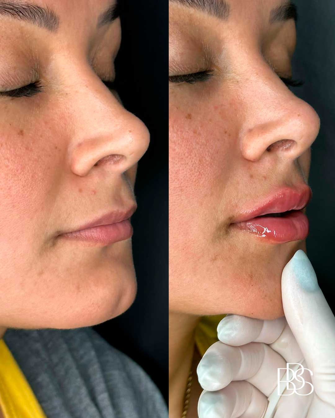 resultado-natural-preenchimento-labial