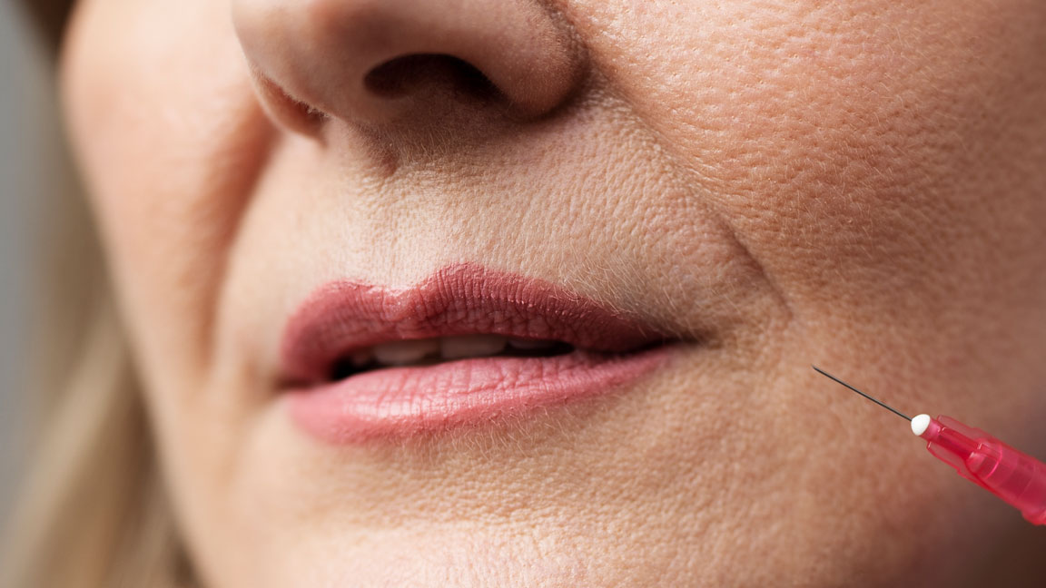 Descubra como eliminar o bigode chinês com os melhores tratamentos, como preenchimento com ácido hialurônico, Botox e bioestimuladores de colágeno. Veja preços e cuidados!